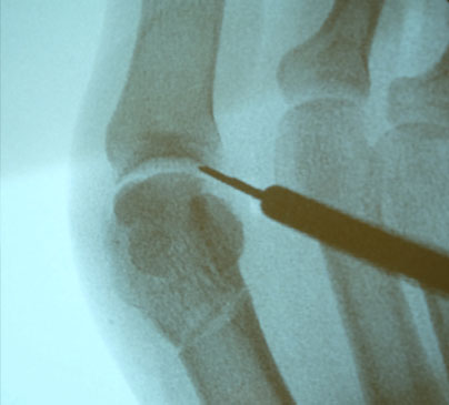 Rontgenfoto van de voet met minimaal invasieve chirurgie (MIS)